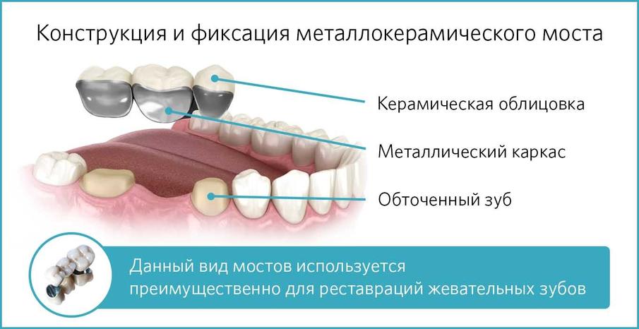 Конструкция и фиксация металлокерамического протеза
