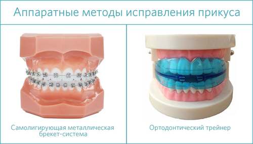 Исправление прикуса с помощью брекетов или трейнеров