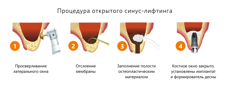 Проведение открытого синус-лифтинга