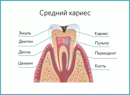 Средний кариес - строение зуба