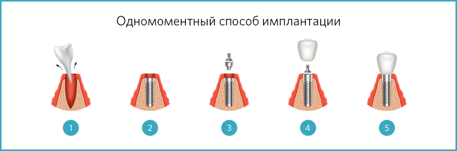 Упрощенная схема восстановления зубов по одномоментному протоколу