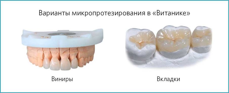 Виниры и вкладки