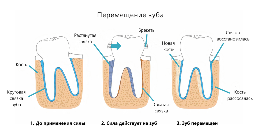Схема перемещения зуба под воздействием брекетов