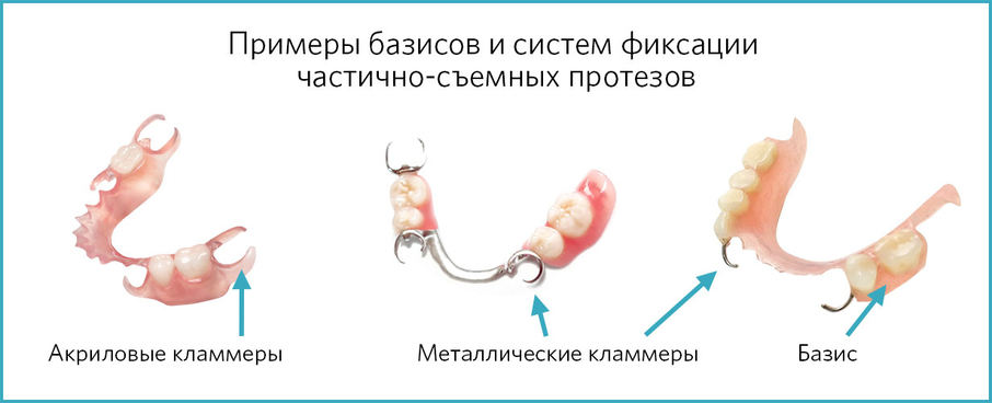 Примеры базисов и систем фиксации частично-съемных протезов