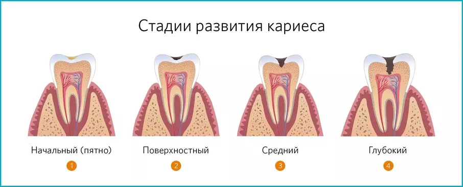 Этапы развития кариеса