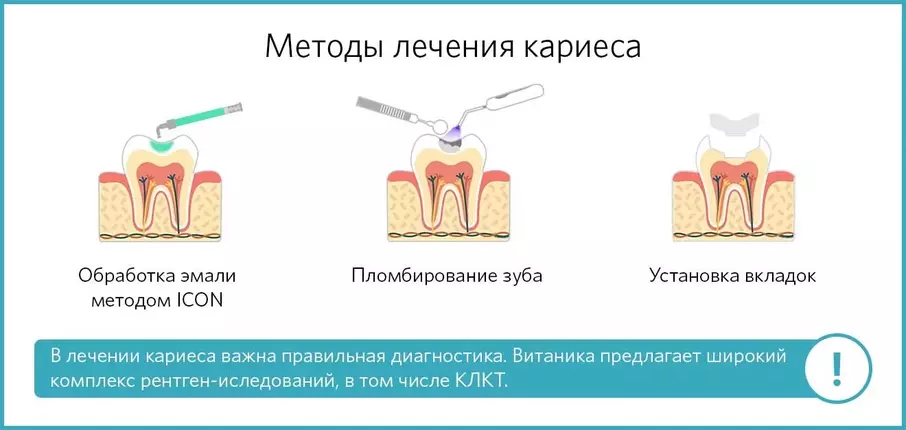 Методы лечения кариеса