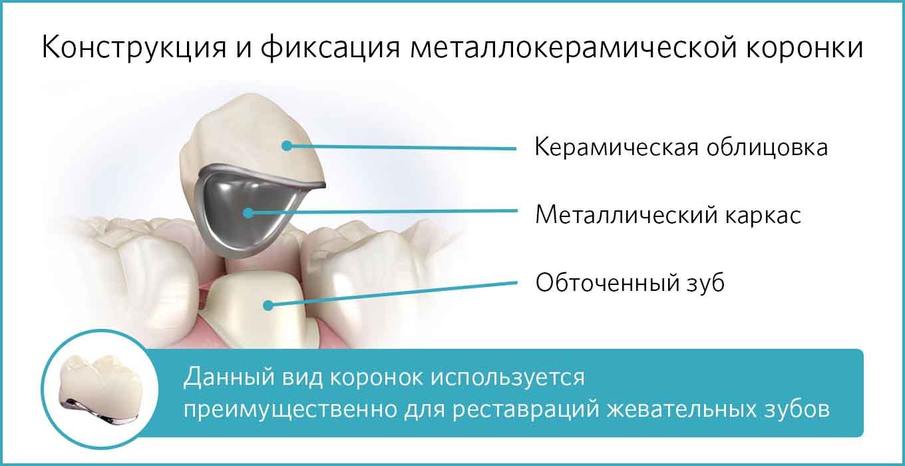 Конструкция и фиксация металлокерамической коронки