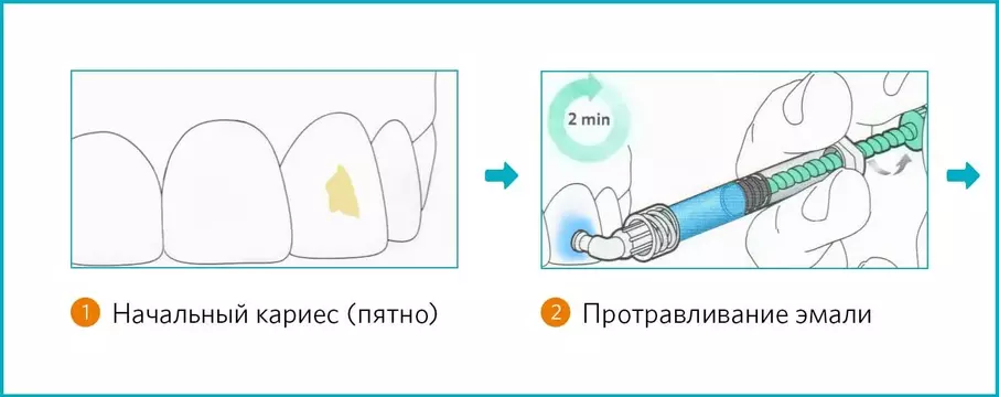 1 этап лечения на ICON
