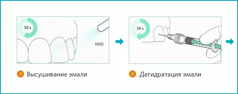 2 этап лечения на Icon