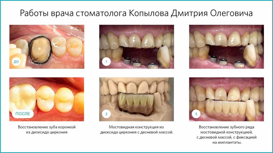 Этапы установки имплантатов