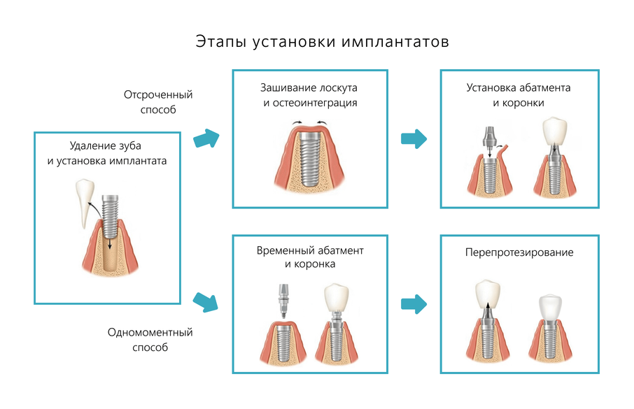 Этапы установки имплантатов