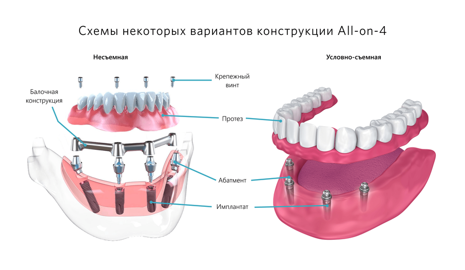 Схема All-on-4
