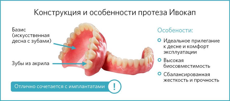 Конструкция протеза ИВОКАП