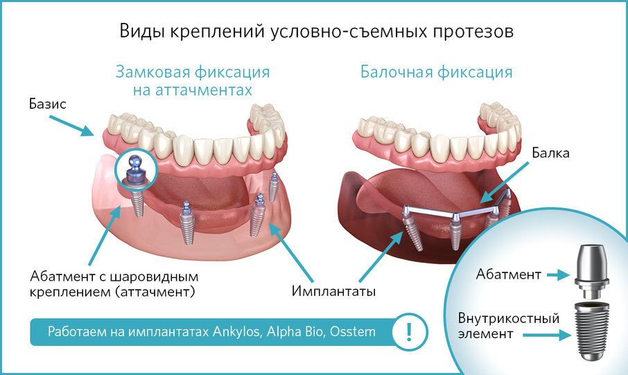 УСП с имплантатами на аттачментах и на балочном креплении