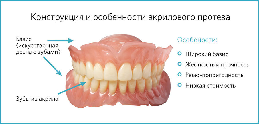 Конструкция и особенности акрилового протеза