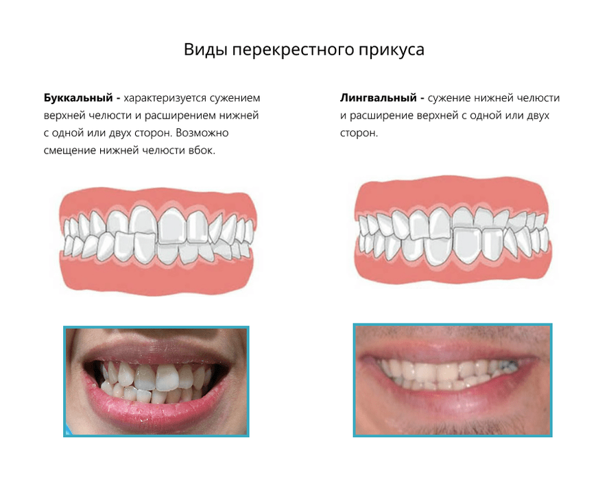 Виды перекрестного прикуса