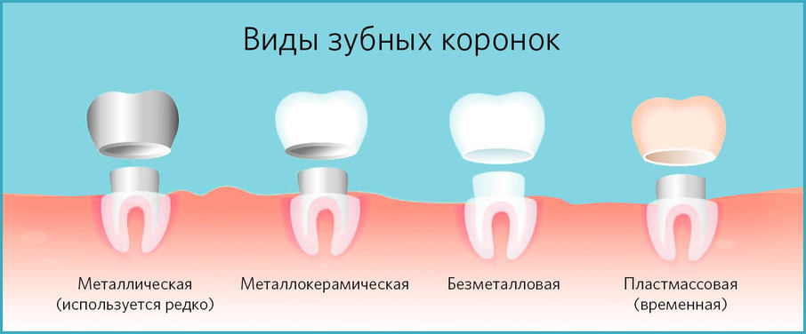 Виды коронок