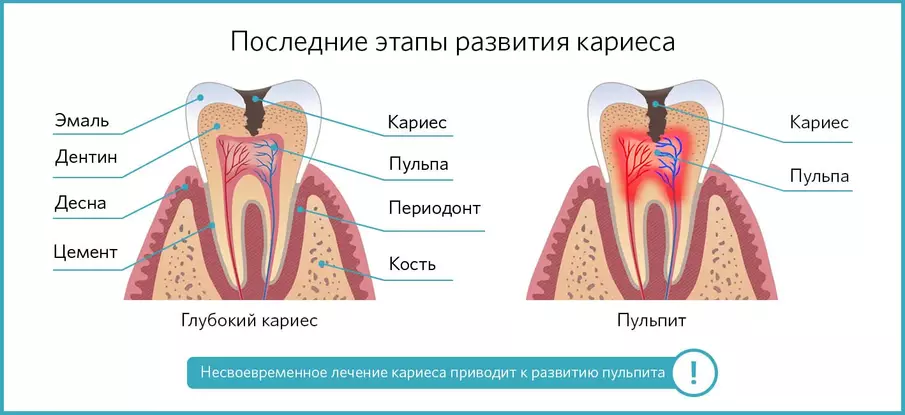 Глубокий кариес и пульпит