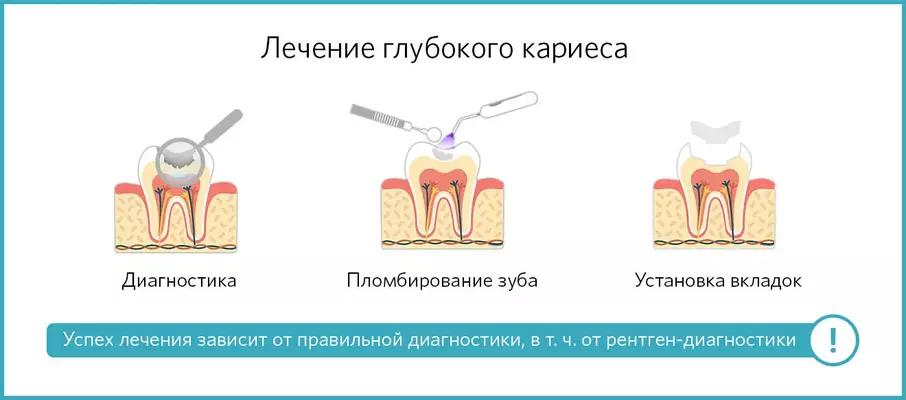 Методы лечения глубокого кариеса