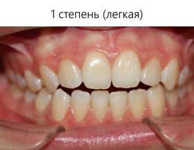 Первая степень открытого прикуса - лечение в Витанике