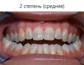 Средняя степень открытого прикуса