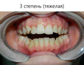 Тяжелая степень открытого прикуса