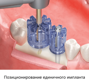 Позиционирование имплантатов Osstem