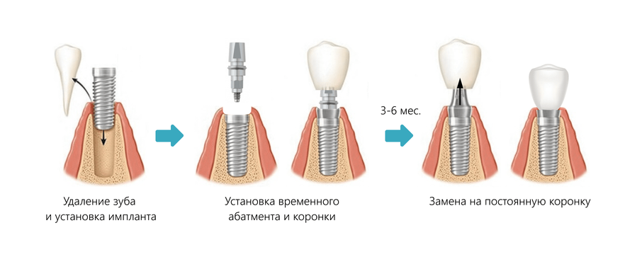 Одноэтапная имплантация