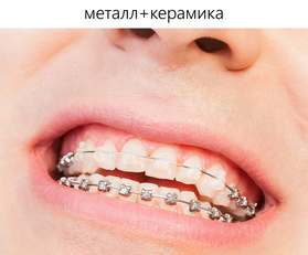 Комбинированные брекеты для установки в стоматологии Витаника