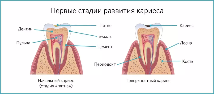 Первые стадии развития: пятно и поверхностный кариес