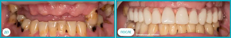 Имплантация по протоколу All on 6: До и после Имплантация по протоколу All on 6: До и после