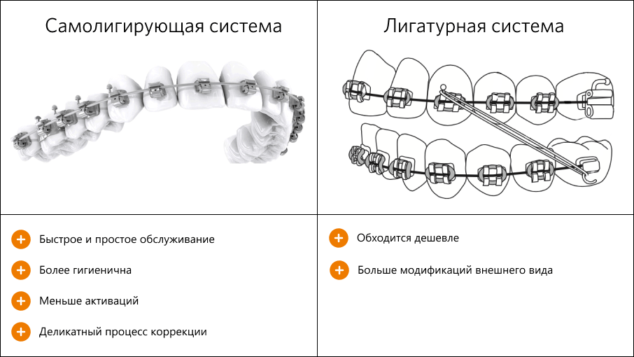 Сравнение самолигирующих и лигатурных систем