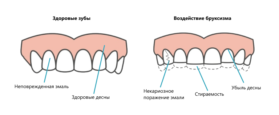 Воздействие бруксизма